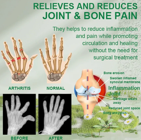 Bee Venom Joint and Bone Therapy Cream BUY 1 GET 1 FREEš„
